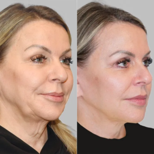 Bellavren Beauty Skincare Anti Aging Roller Essence Booster
