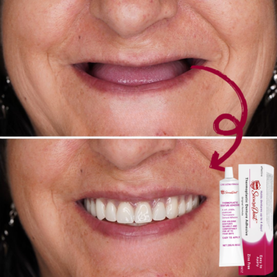 SecuraDent™ Thermoplastic Denture Adhesive with Vegetable Cellulose, Aloe Vera, and Chamomile