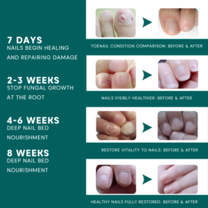 NailRenew Onychomycosis Pen