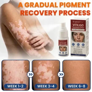 Sylovona Glow™ Vitiligo Treatment Spray in a 30ml airless pump bottle