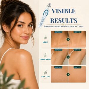 Luxevéria Mole Removal Roller Pen