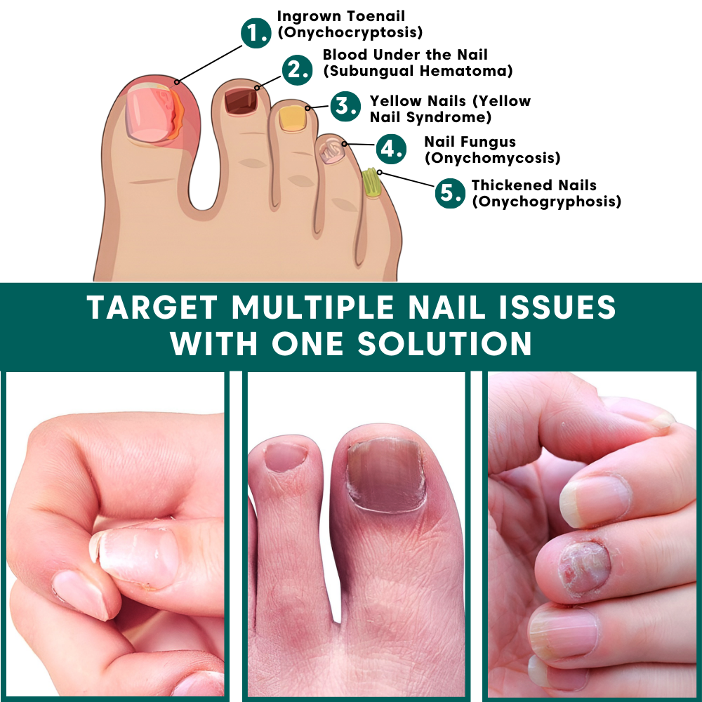 NailRenew Onychomycosis Pen with tea tree oil and castor oil