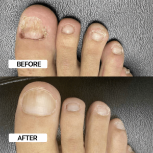 Nagelfrid™ FungiFix Nail Spray for daily nail care