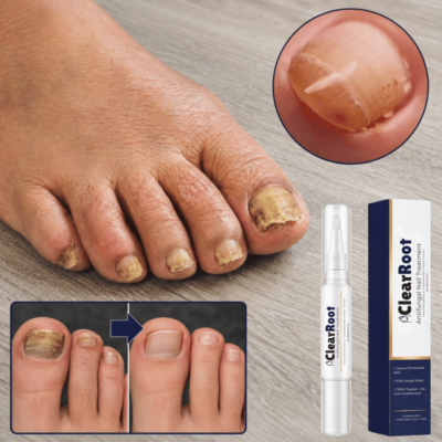 ClearRoot™ Nail Care Pen with urea and undecylenic acid