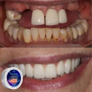 Veneerly™ Silicone Denture Set for cosmetic smile wear
