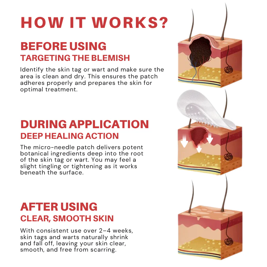 Fivfivgo® MicroNeedle Botanic Skin Tag Removal Patch with Calendula and Tea Tree Oil
