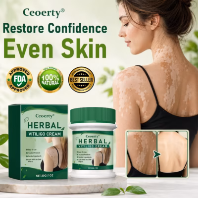 Ceoerty® Herbal Vitiligo Cream with aloe vera, licorice, and turmeric