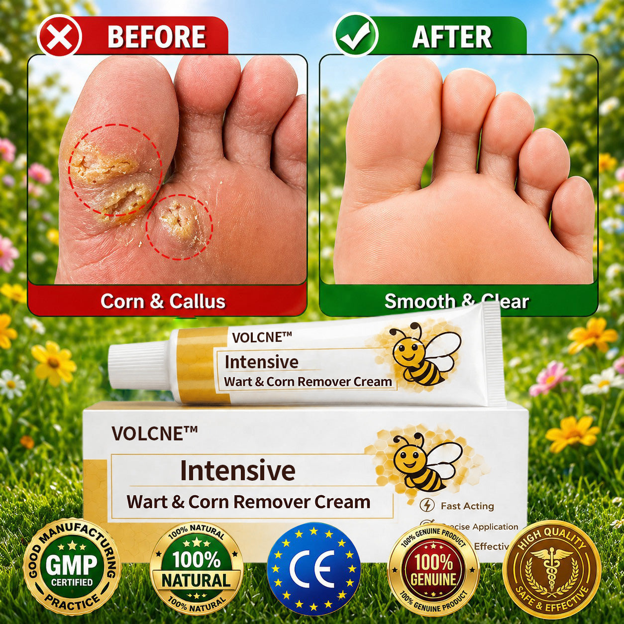 VOLCNE™ topical wart and corn remover cream