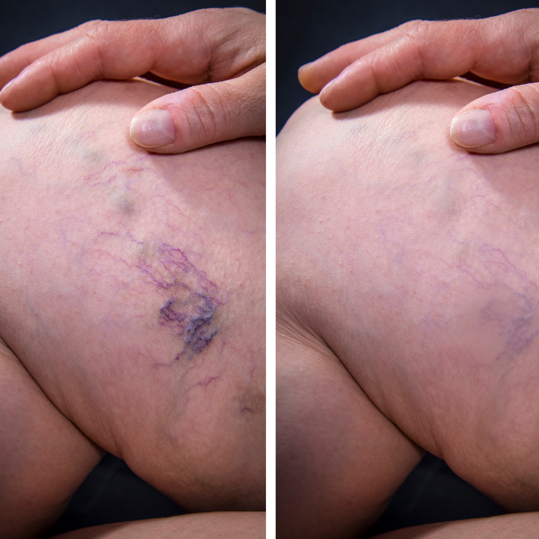 VariClex™ Leg Serum