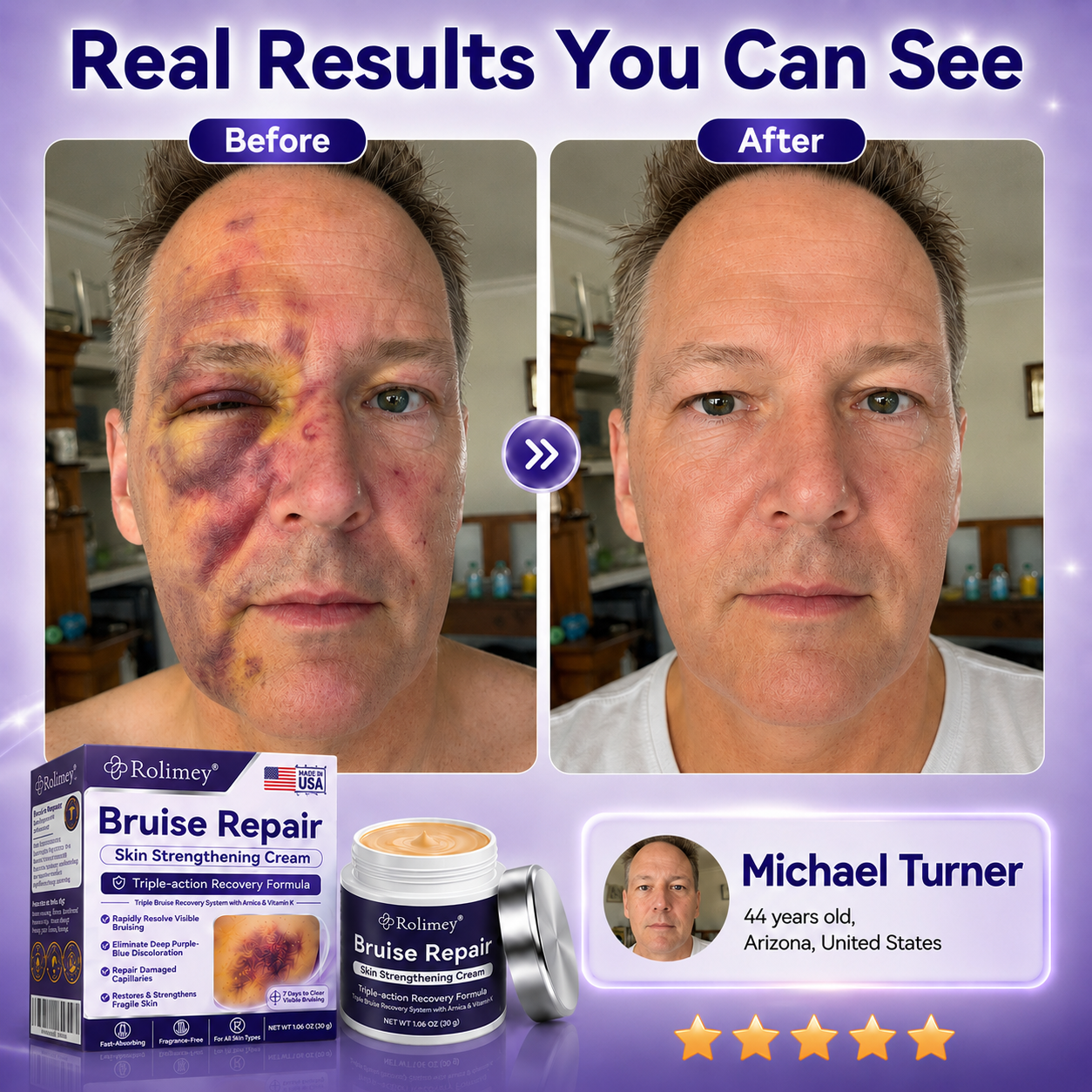Rolimey® Bruise Repair Cream with arnica