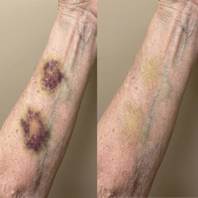 Ivara™ ceramide cream for daily fragile skin care