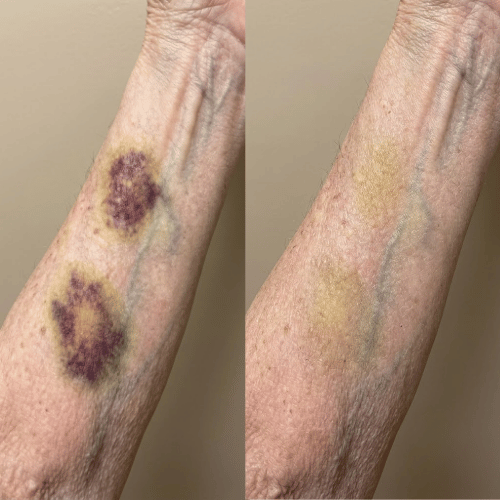 Ivara™ ceramide cream for daily fragile skin care